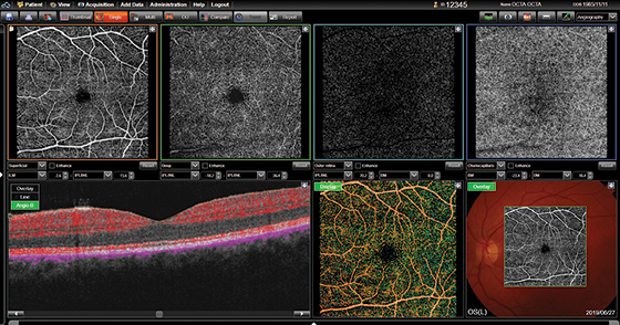 SS OCT Angio SS OCT Angio