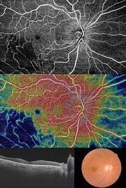 Swept Source OCT Angio